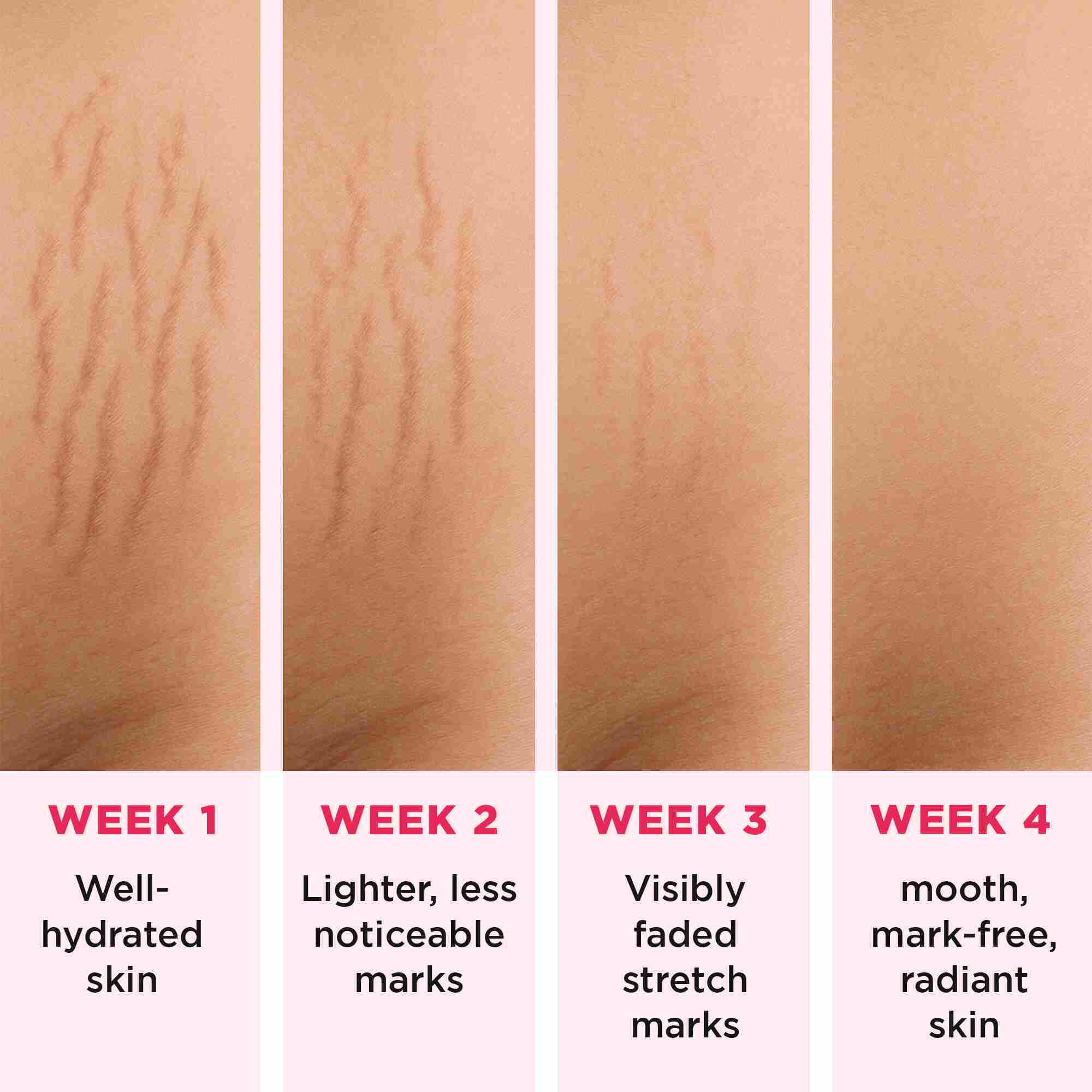 roll on serum stretch marks