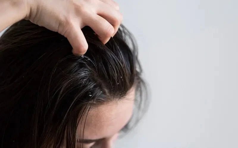 Get Flake-free Scalps with Orgatre Dandruff Shampoo for Women